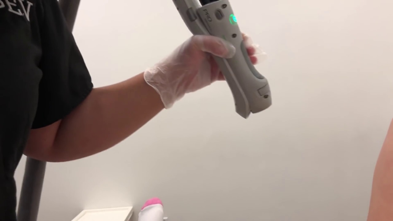 BRAZILLIAN LASER TREATMENT GONE WRONG!!! YouTube