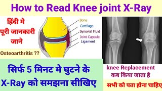 How to read Knee joint x-ray X-Ray Knee replacement