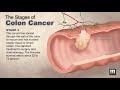 Stages of Colon Cancer