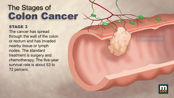 Stages of Colon Cancer - DayDayNews