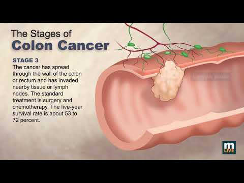 Stages of Colon Cancer