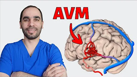 Arteriovenous Malformation AVM: Causes, Testing and Treatment