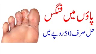 Foot fungus permanent treatment in Rs 50 only screenshot 4