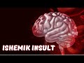 ISHEMIK INSULT |  ИШЕМИК ИНСУЛЬТ