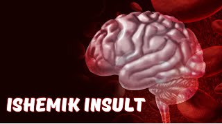 ISHEMIK INSULT |  ИШЕМИК ИНСУЛЬТ