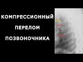 Компрессионный перелом позвоночника