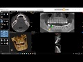 CS 3D Imaging - Implants nouvelle version 1.18