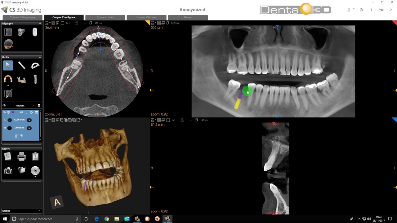 CS 3D Imaging - Implants nouvelle version 1.18