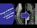 Amazing device for SCOLIOSIS restores range of motion and improves treatment without surgery