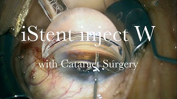 Combined Cataract Surgery with iStent Inject W Implantation
