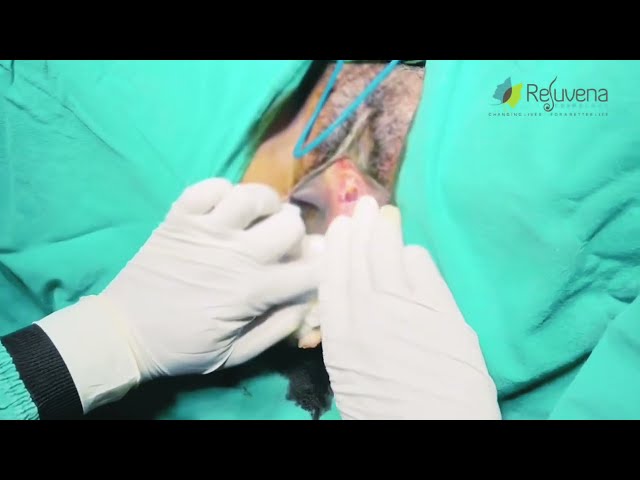 Hymen Repair Procedure - Hymenoplasty Surgery | Dr Deepesh Goyal | class=
