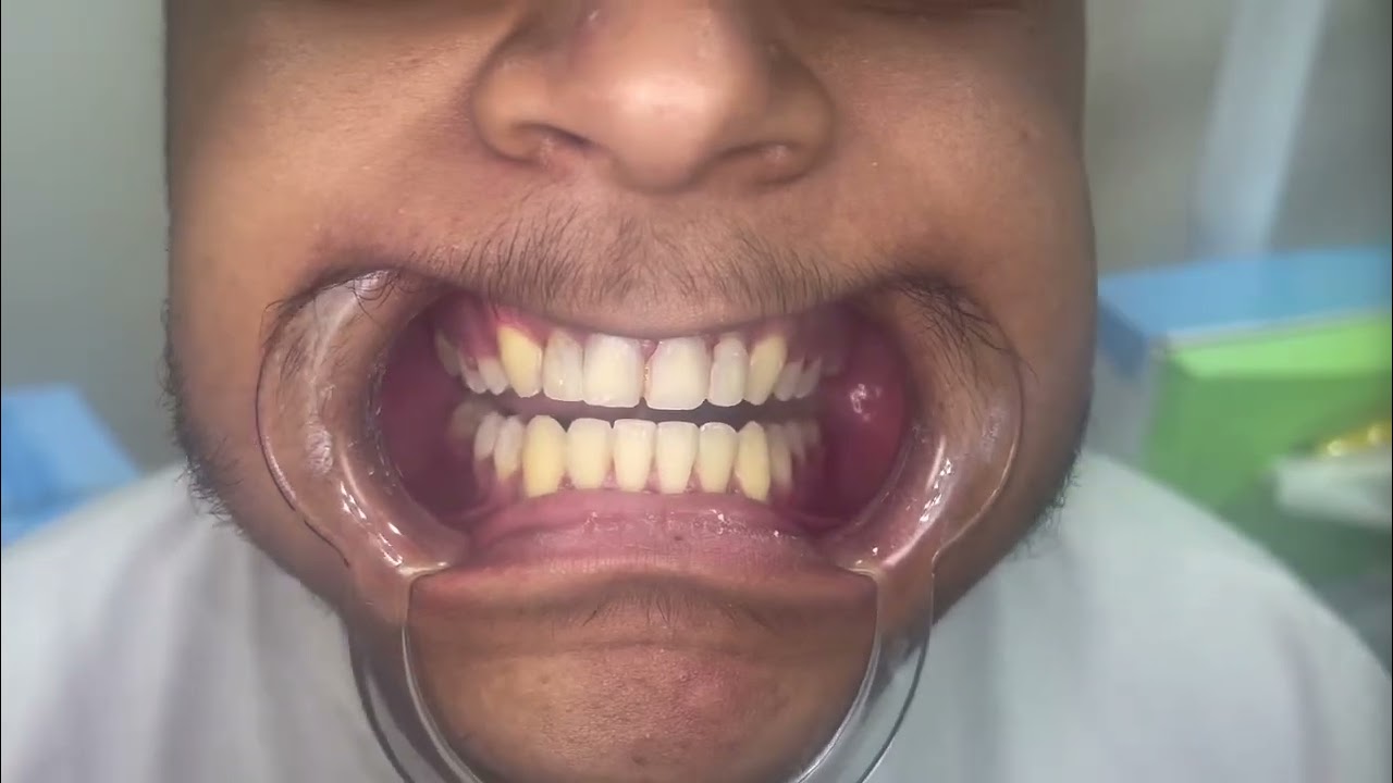علاج العضة الامامية العميقة و ازدحام الأسنان الشديد#تقويم#عضة#deepbite#dentist#dentalcondition  