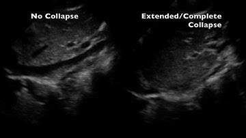 IVC: No Collapse Vs. Extended Collapse