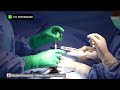 ZSR Stapler Circumcision | Fast, Painless & Bloodless Procedure | Kannada