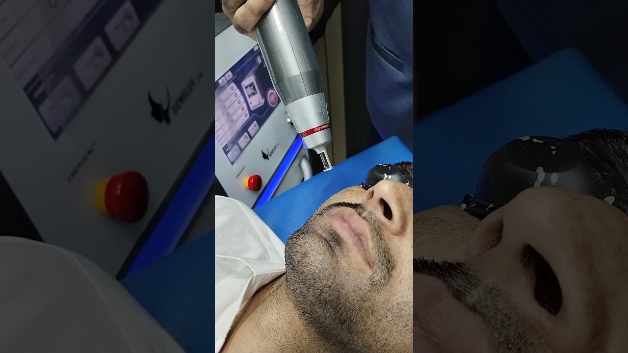 Q-Switch ND YAG Laser for Melasma | Best Laser Treatment for Dark Spots & Pigmentation #melasma