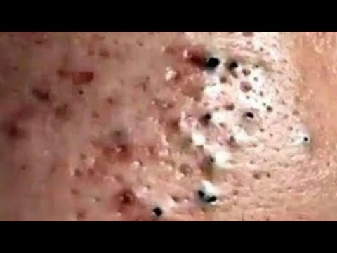 For real though how can you watch pimple popping videos 🤢 This tool i