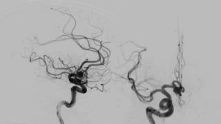 Aneurysm ACoA   WEB Device