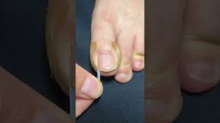 Toe Nail Fixer| Ingrown Toenail Cleaning & Care #ToenailFix #NailCare #FootCare #PedicureClean