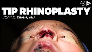 Tip Rhinoplasty By Dr. Rohit K. Khosla Case Trailer