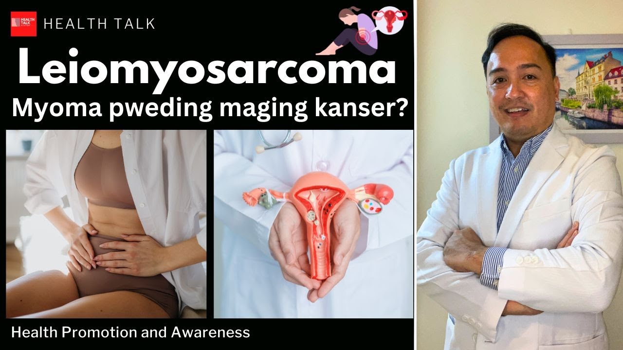Leiomyosarcoma: Myoma pwedi bang maging Cancer?