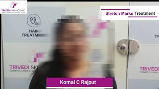 GOODBYE FOREVER - Stretch Marks Remove Treatment | Komal  C Rajput | Trivedi Skin Clinic | Surat-Guj