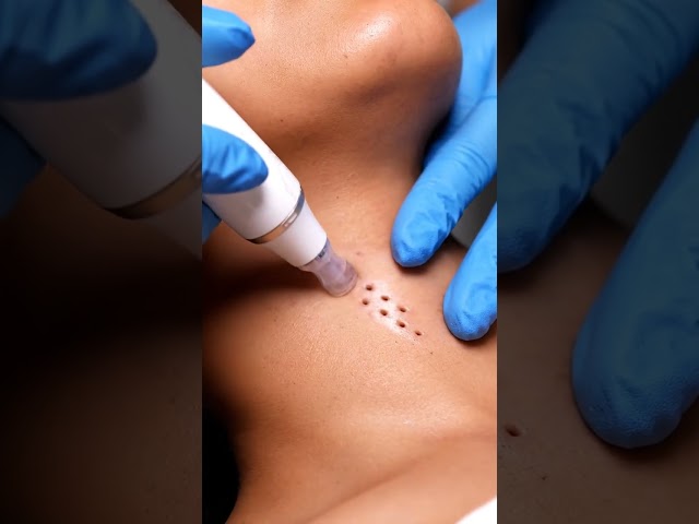 Deep Pore Blackhead Removal Transformation