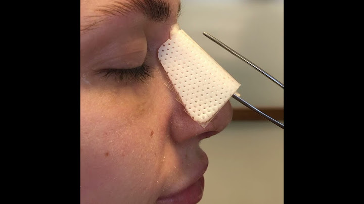 See This Rhinoplasty Splint Removal At The Facial Center For Plastic Surgery!