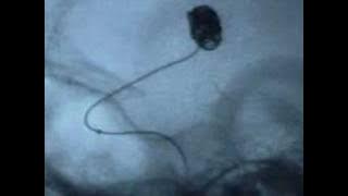 Coil embolization of aneurysm