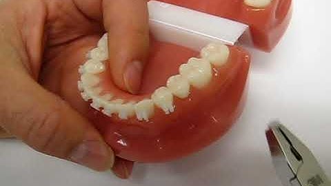 Debonding 3M™ Clarity™ Advanced Ceramic Brackets off the archwire