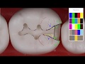 Class II Amalgam #19 MO Acadental