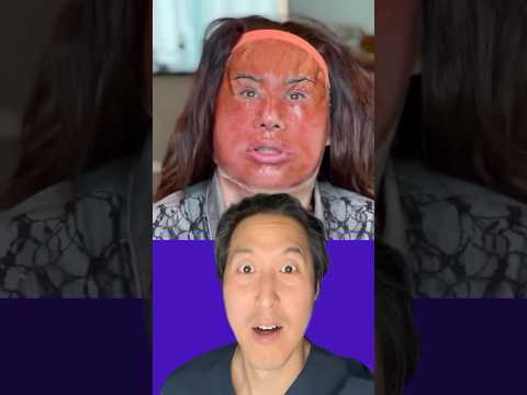 Deep Phenol Peel-