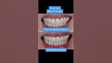 Close Your Black Triangles With the Bioclear Method 100% Non Invasive