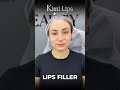 Lip Contour at Cici Beauty – Natural Lip Definition in Hanoi Lip contour is a subtle filler techniq