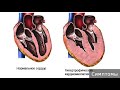 Кардиомиопатия. Как лечить кардиомиопатию.