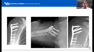 Proximal humerus fractures