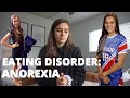 My Eating Disorder Story: Anorexia
