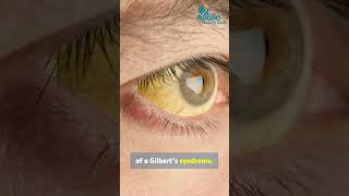 Aperçu Du Syndrome De Gilbert Dr Jatin Apollo Hospitals