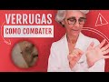 Combata as verrugas de forma simples