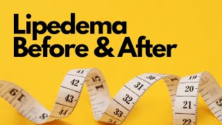 Lipedema Before And After - Weight Loss and Keto Success