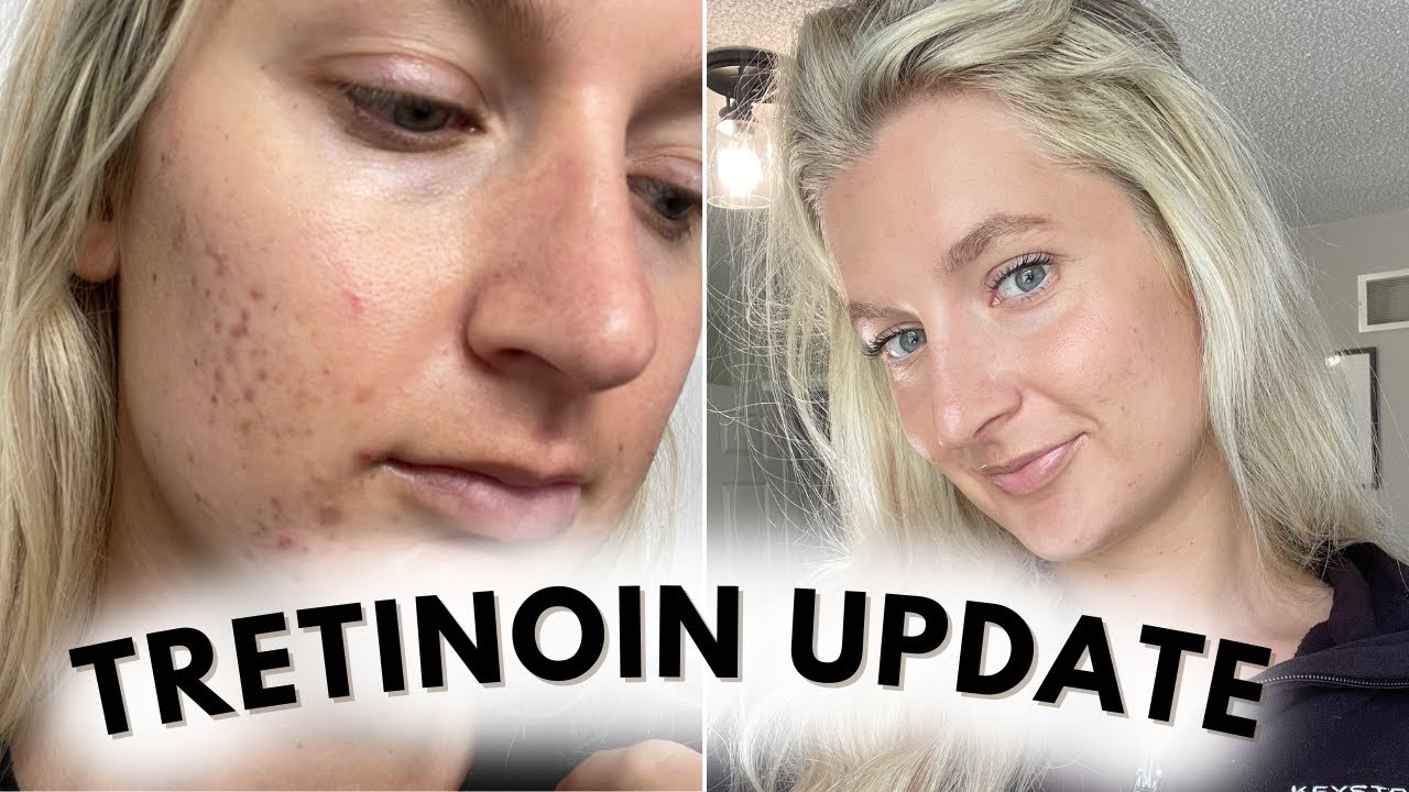 5 Month Update on Tretinoin! *How to Get Glowy Skin | Acne Prone Skin*