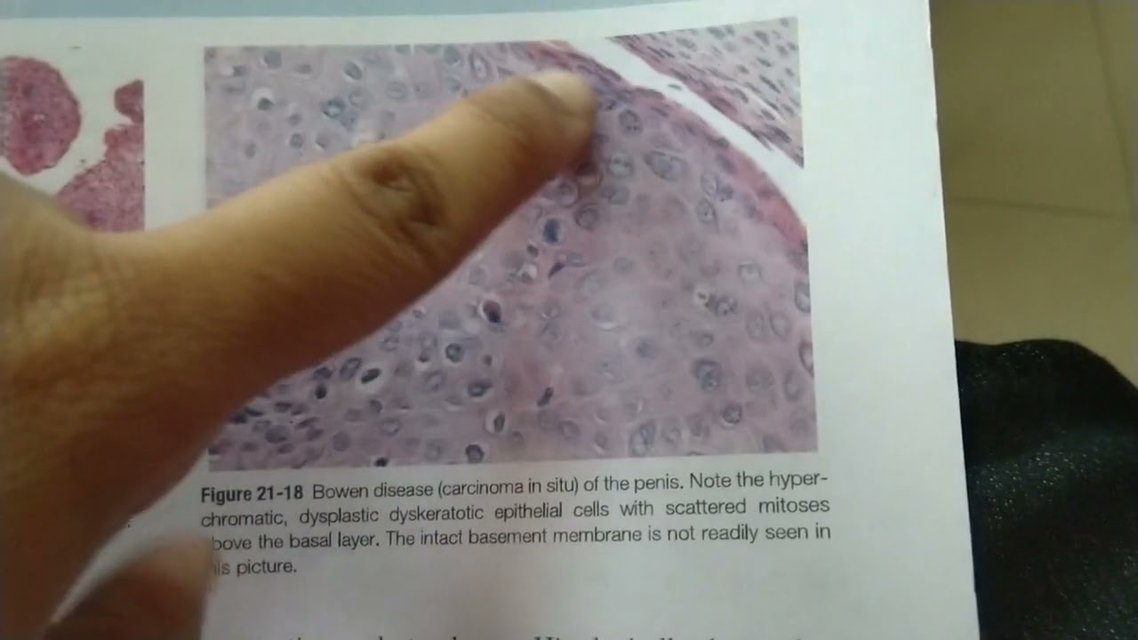image   bowens disease || Pathology