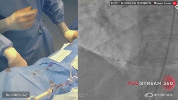 Step by step approach to CTO PCI for the non CTO Operator