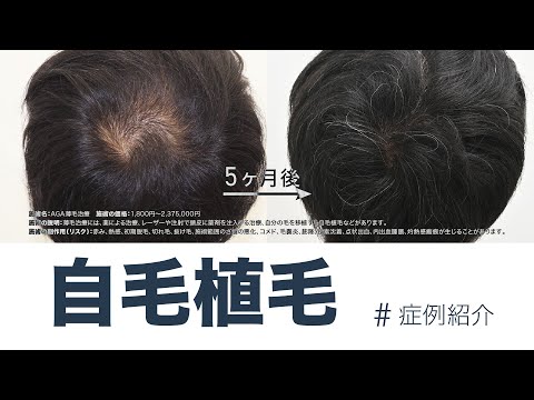 植毛完全ガイド : 世界のスタンダードFUT治療の流れ : 最新版 症例紹介】自毛植毛/スマートFUE植毛1,400グラフト-5ヶ月後まで