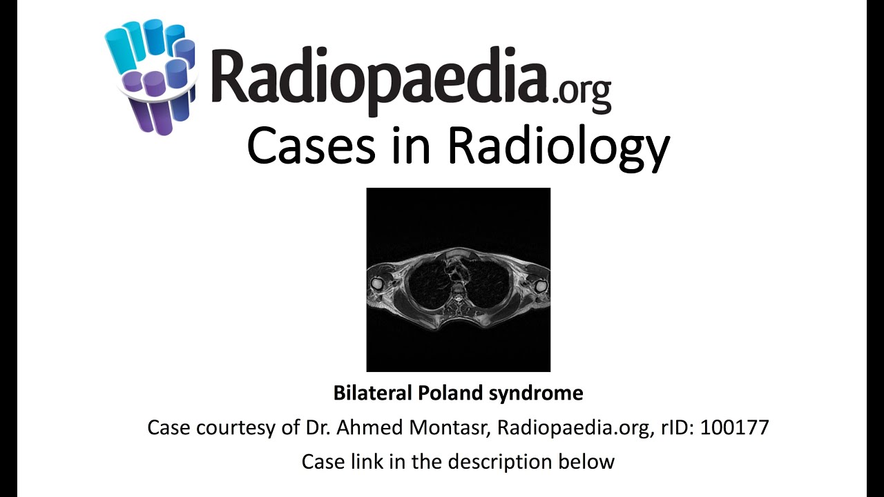 Bilateral Poland syndrome Cases in Radiology YouTube