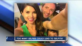 Too many selfies could lead to 'selfitis'