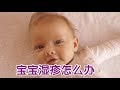 宝宝湿疹怎么办？|育儿技巧Parenting Tips:Baby Eczema