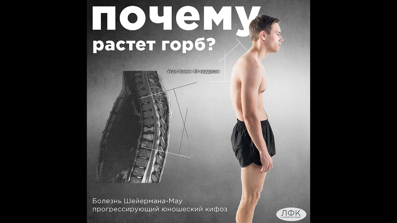 Почему вырастает горб на спине?