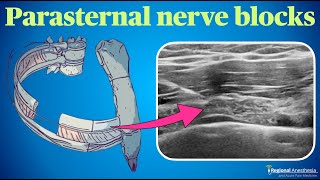 Parasternal Nerve Blocks
