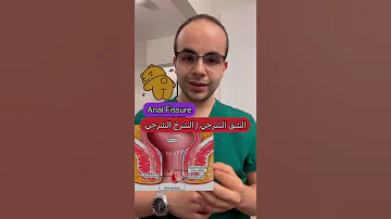 Anal Fissure الشق الشرجي الشرخ الشرجي 