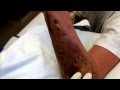 Third degree burn